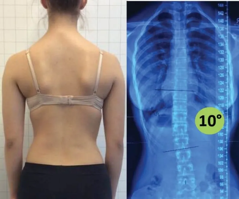Atlanta Scoliosis Center